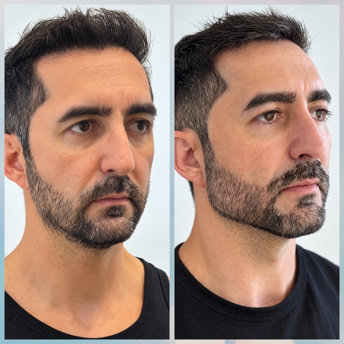 Antes e depois Perfiloplastia Masculina Joana Cardoso