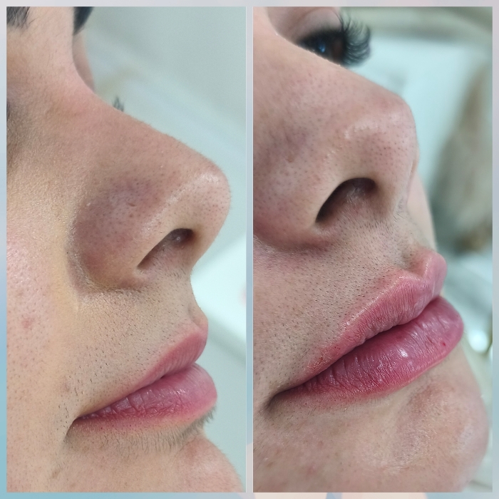 Preenchimento e Escultura Labial Joana Cardoso